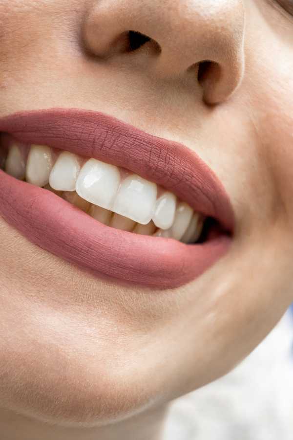 Close-up of a patient's whitened, glossy smile