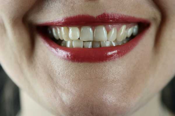 Close-up front view of a patient's smile showing straight, white teeth