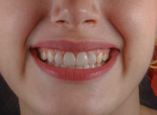 Close-up of a smile before cosmetic dental treatment