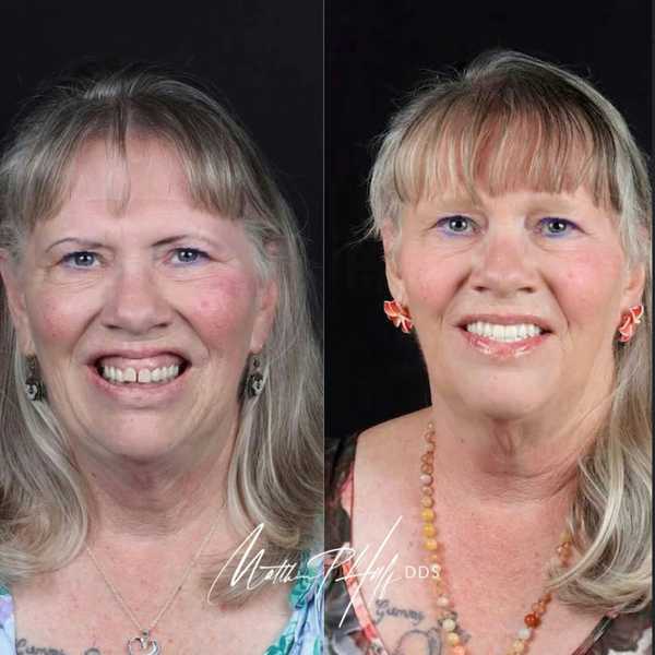 Side-by-side before and after comparison of a patient's smile transformation
